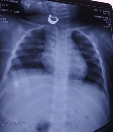 CXR– Grossly Normal