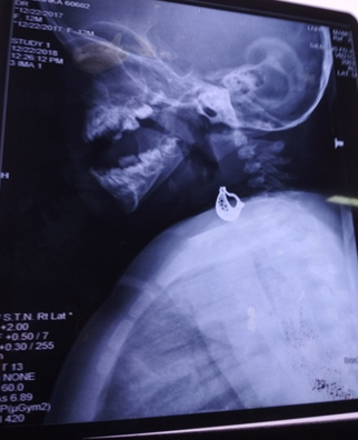 Repeat CXR showing foreign body at same site.