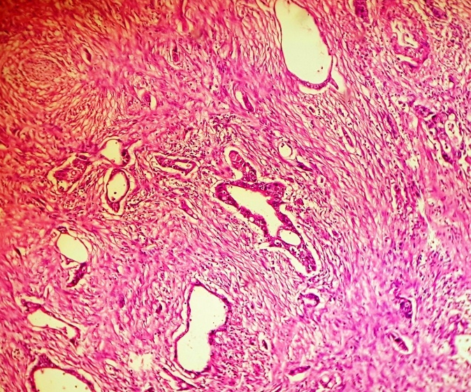 Pancreatic adenocarcinoma- tubular and dilated glands lying in a dense desmoplastic stroma
