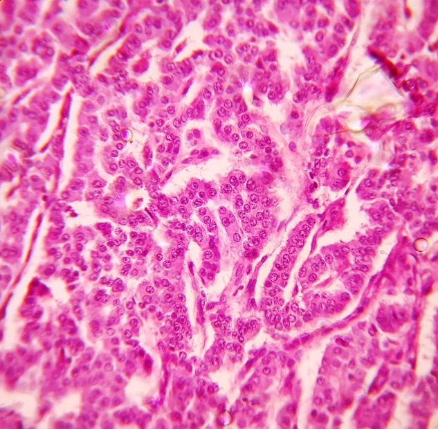 Pancreatic neuroendocrine neoplasm- ribbons and insular pattern of neoplastic cells with powdery chromatin