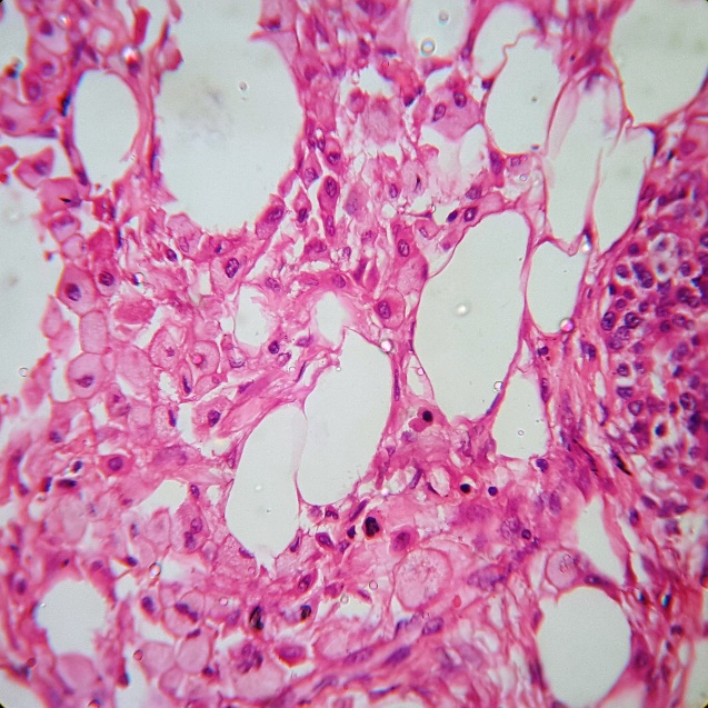 Chronic pancreatitis-fat necrosis