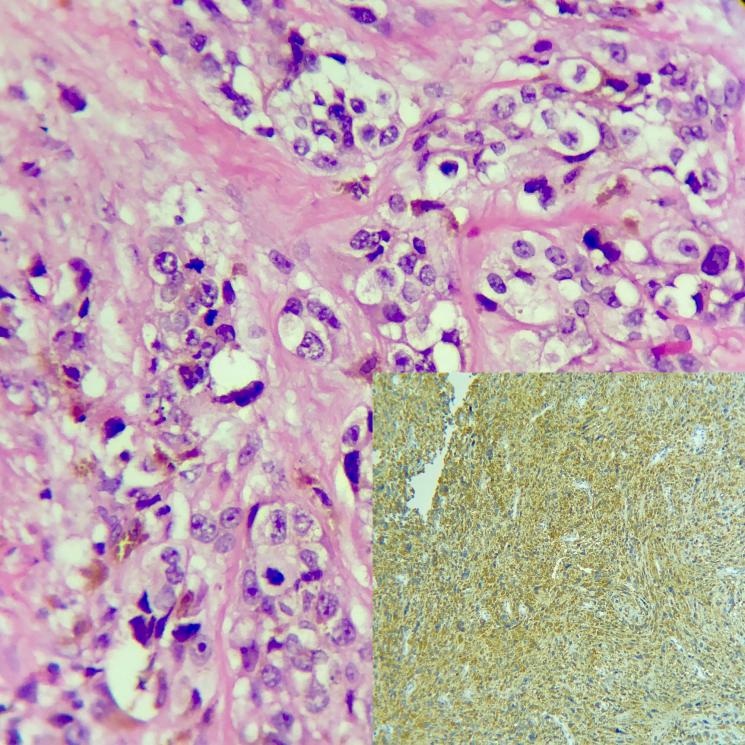 Photomicrograph of malignant melanoma. Melanocyticatypia with prominent nucleoli and finely dispersed chromatin. (H&E, 400X)Inset: HMB-45 immunoreactivity noted. S-100 reactivity was also noted.