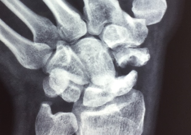 Preoperative X-ray - Scaphoid view