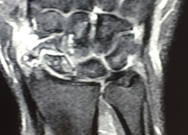 Preoperative MRI - Wrist