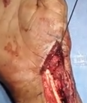 Provisional K wire fixation