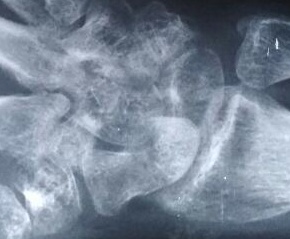 Preop radiograph