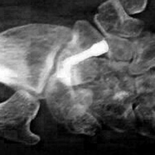 Three-month postop radiograph