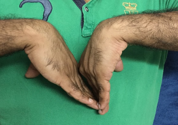 Palmar flexion (post op)