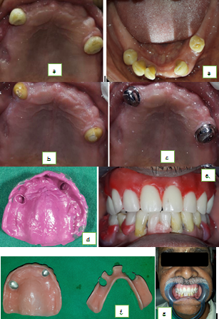 a: Pre-op maxilla and mandible, b: Tooth preparation of 13,24, c: Cementation of metal copings, d: Final impression of maxilla, e: Wax trial in the patient, f: Completed maxillary and mandibular dentures, g: Maxillary overdenture with mandibular RPD insertion
