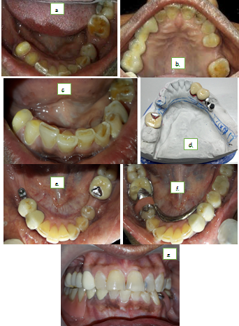 a: Pre-op mandible with missing 45,46,47, b: Pre-op maxilla with missing 25, c: Tooth preparation done in 43,44, Fig 2d: PFM crowns with custom bar and ball attachment, e: PFM crowns cemented on 43,44, f: Framework insertion in andibular arch with attachment and rests on 34,36, g: Post-op view