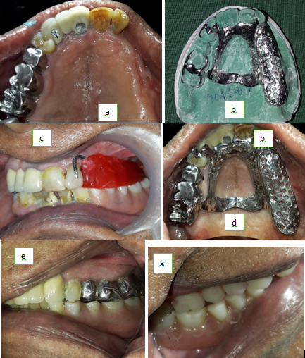 a: Pre-op maxillaryocclusal view, b: Metal framework on master cast, c: Framework trial in patient, d: Inter-occlusal record, e: Post-op right lateral view, f: Post-op left lateral view