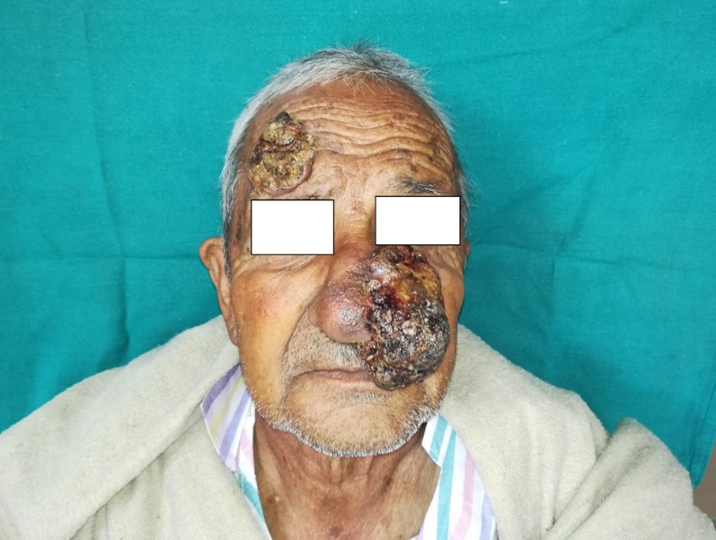 Giant exophytic growth of size 10cm*6cm*5cm, encroaching whole left lateral nasal wall, left upper-lower lip and left cheek with areas of necrosis.