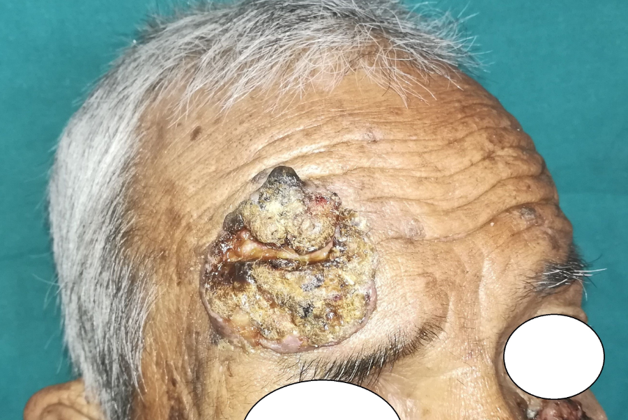 Another similar growth of size 5cm*5cm*2cm present on right side of forehead.