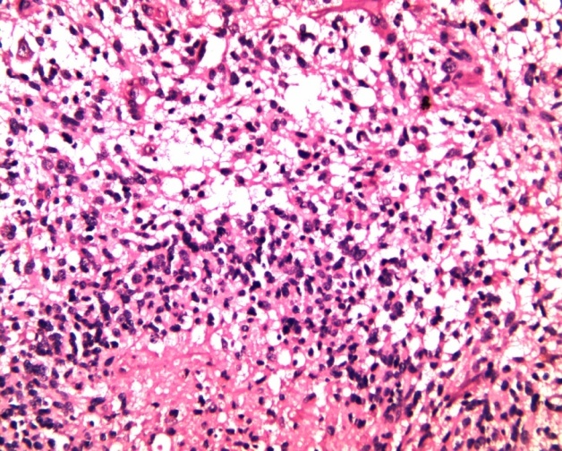 Glioblastoma, NOS showing palisaded necrosis (H&E, x100)