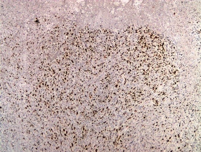 Glioblastoma showing High Ki67 Labeling index (Ki67 IHC, x40)