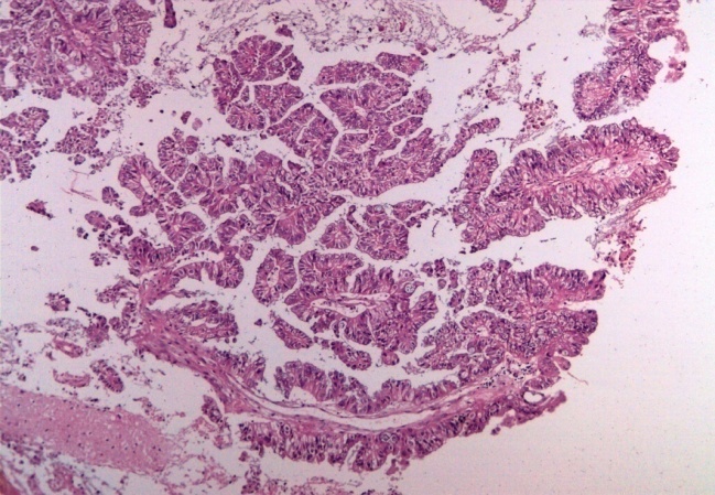 Choroid plexus carcinoma showing atypical lining in papillae (H&E, x100)