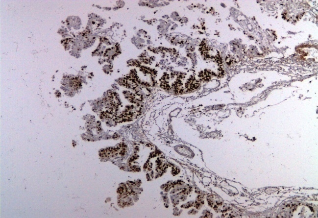 Choroid plexus carcinoma showing elevated Ki67 LI(Ki67 IHC, x100)