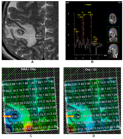 Right Parietal SCG with partial resolution; A. Granulomatous lesion with scolex with surrounding oedema; B. MRS showed low metabolite levels, as well as a lactate peak; C. Lower NAA/Cho ratio on MRS (arrow); 4. MRS depicting higher Cho/Cr ratio (arrow). Patient had partial resolution of the lesion on follow up imaging.