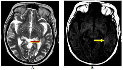 Left Temporal SCG with no resolution; A. T2W image shows a small hyperintense area and minimal perilesional oedema; B. The perilesional hyperintensity better demonstrated (yellow arrow) on T1-MT images is seen to extend beyond the abnormality (red arrow) seen on T2-W images and is suggestive of perilesional gliosis. Patient had no resolution of the lesion on follow up imaging.