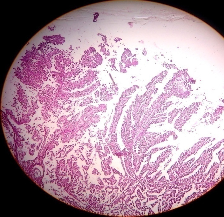 Photomicrograph of showing well differentiated papillary adenocarcinoma. (H & E 40x)