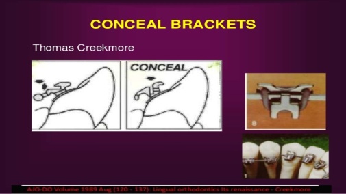Conceal Bracket by Thomas Creekmore