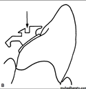 Fujita lingual Bracket