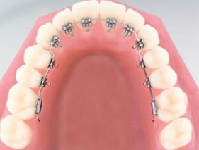 Stealth Brackets