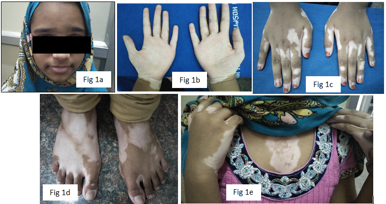 Vitiligo Vulgaris