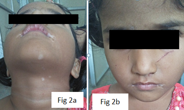 MucosalVitiligo