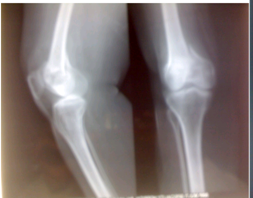 Pre operative Radiograph