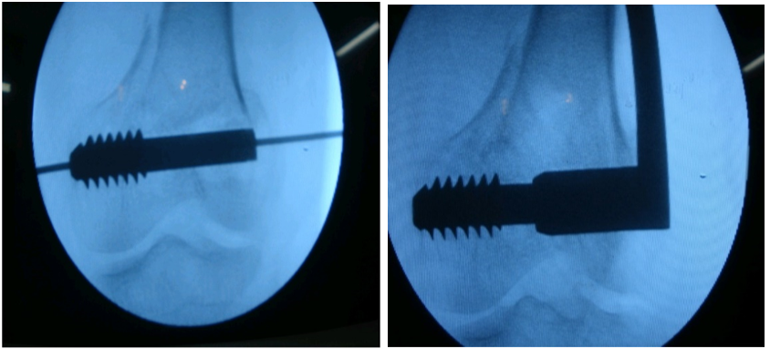 Intra operative radiograph