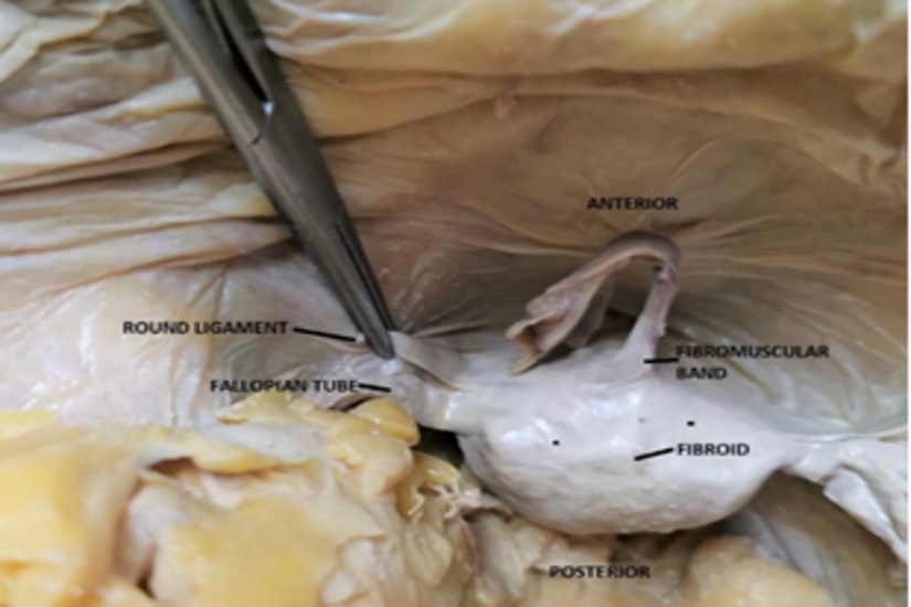 Superior view of pelvic cavity showing relation of uterine parts and fibroid on the external surface. Fibromuscular band from anterosuperior part of uterus