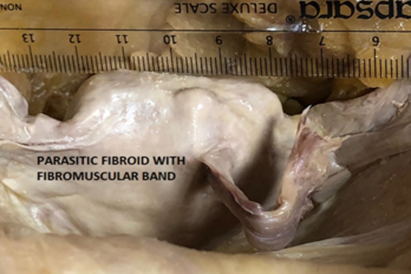 Anterior view of uterus showing the fibromuscular band of parasitic fibroid