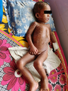 Secondary bacterial infection in a child 