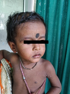  Xerosis in a child 