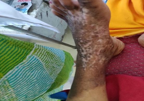 Foot dermatitis in an adult 