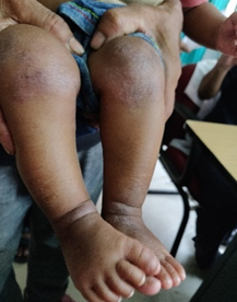 Extensors involvement in a child 