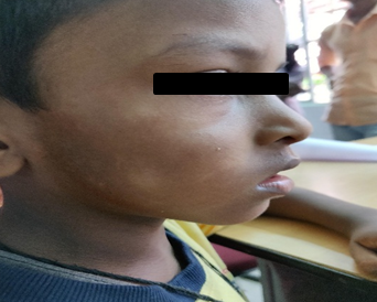 Pityriasis alba in a 6 year old boy