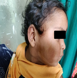 Facial involvement in a child