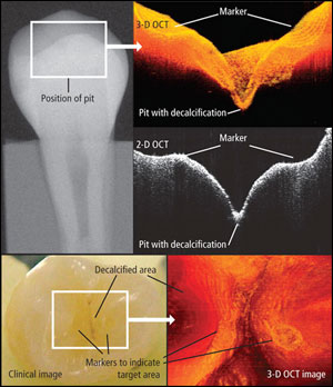 Optical Coherence Tomography (Pic courtesy:- https://ipj.quintessenz.de)
