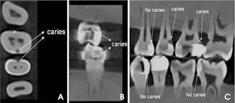 Examples of CBCT imagesdemonstrates either secondary caries present or absent. A. Axial plane. B. Coronal plane. C. Sagittal plane.(Pic courtesy:- Korean Academy of Oral and Maxillofacial Radiology)