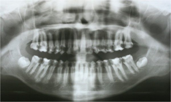 OPG showing Pretreatment interproximal caries (Pic courtesy:- Chun-Hung Chu, Jan 09, 2014)
