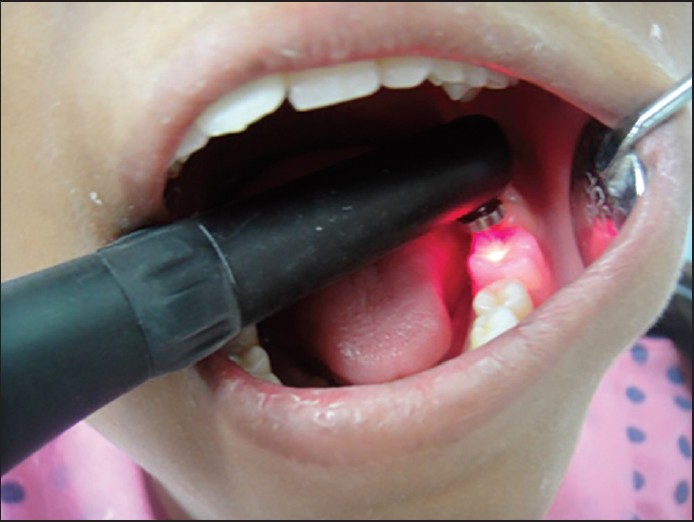 Clinical examination using the DIAGNOdent device device,pic courtesy (Pic courtesy:- Goswami M, Rajwar AS. J Indian Soc Pedod Prev Dent 2015;33:10-4)