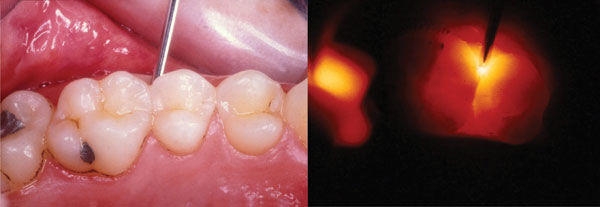 Fiber-optic transillumination (Pic courtesy:-A.F. Hall)