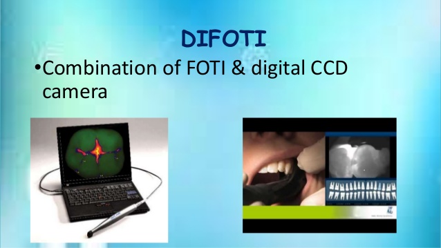 Digital Fiber-optic transillumination (Pic courtesy:- Keerthana Ravi)