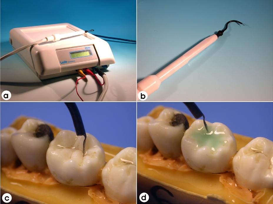 -The ECM device (Version 4) and its clinical application. (a) The ECM machine, (b) the ECM handpiece, (c) site specific measurement technique, (d) surface specific measurement technique. (Pic Coutesy:-Pretty, 2006)