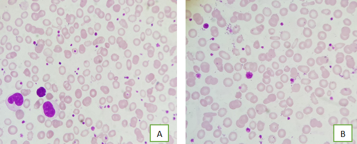 A : (10x):thrombocytosis in IDA ; 1B : (40x):variations in platelet size in IDA.