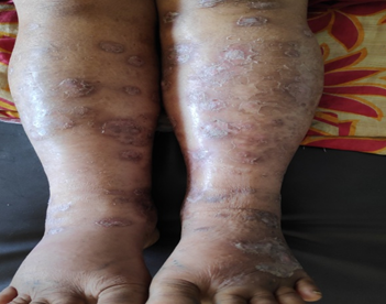 Stasis dermatitis in a female in a 7 year old child