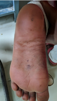 Juvenile plantar dermatoses Patient