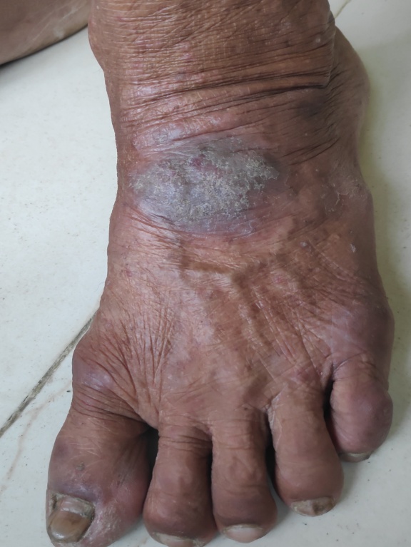 Nummular eczema of lower leg
